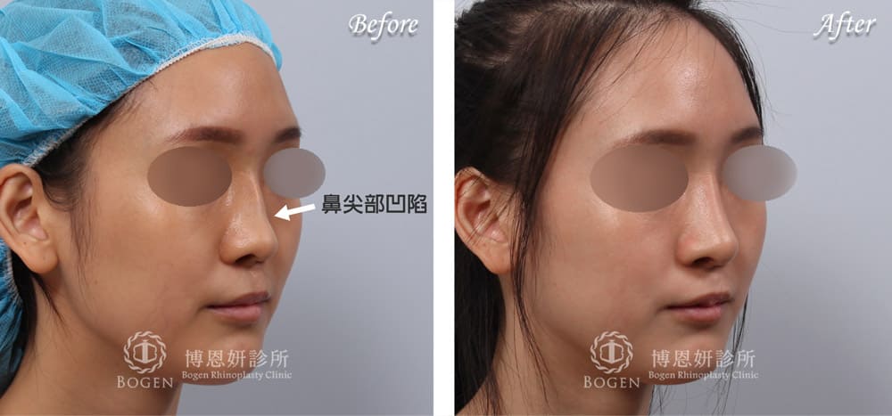 博恩妍診所張簡醫師修復珍珠肋軟骨造成的鼻尖凹陷